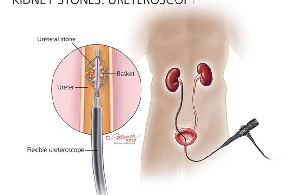 Treatment of Kidney Stones: Mini-PCNL, URS, RIRS, CLT